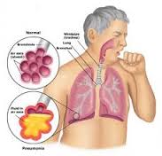 Penyakit Penyakit Pernafasan Yang Paling Sering Diderita Oleh Orang.